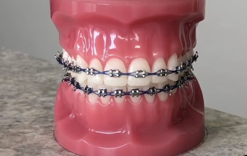 Black braces for a good looking smile