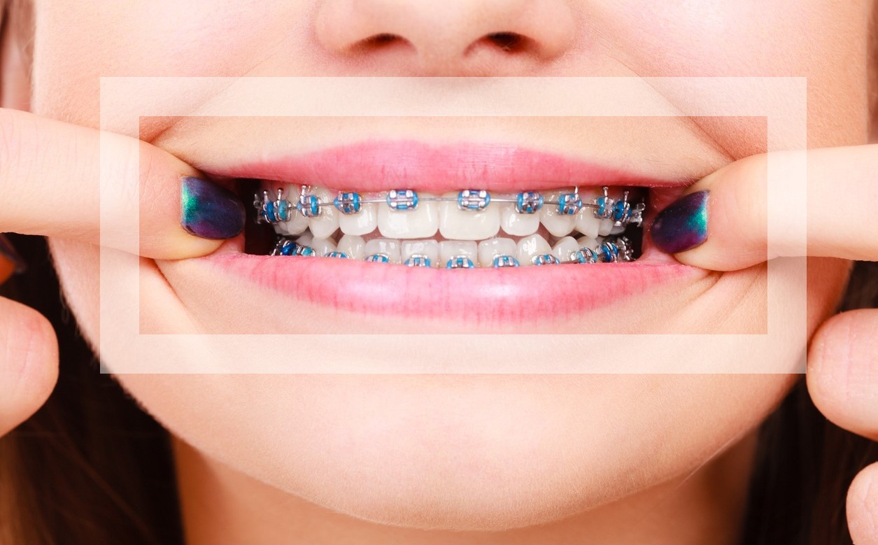 light blue and light pink braces