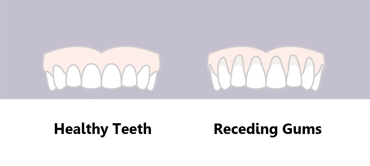Receding gums, syptoms, causes, prevention