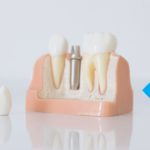 Dental conditions which oral care device do I need